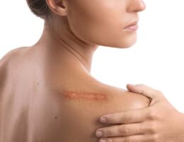 Woman with a scar on her shoulder